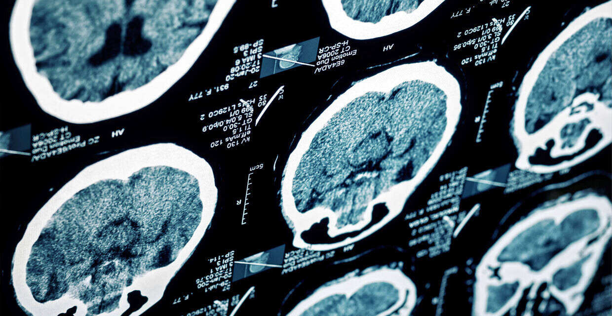 The six signs of a stroke that AREN'T the ones you've been told