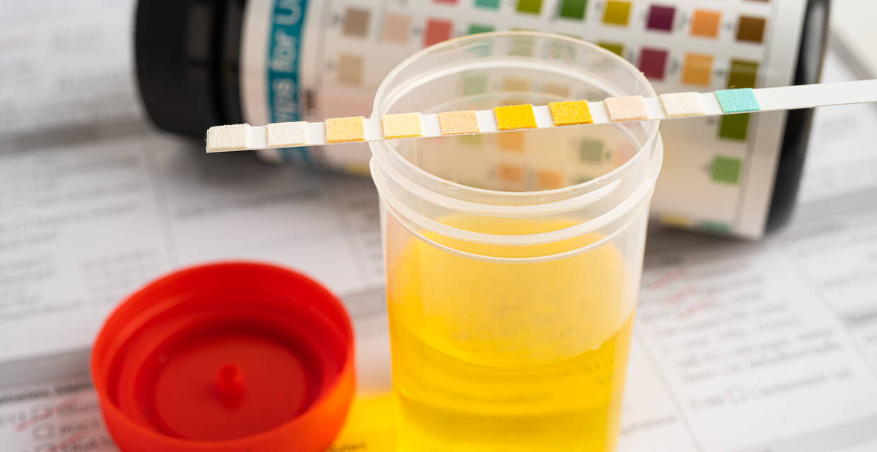 Glucose in Urine: Symptoms, Test, Causes, and Treatment Glucose in Urine: Symptoms, Test, Causes, and Treatment