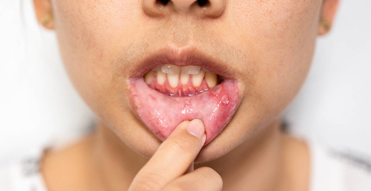 Oral Herpes: Symptoms \u0026 When To See A Doctor, image size:1240x640